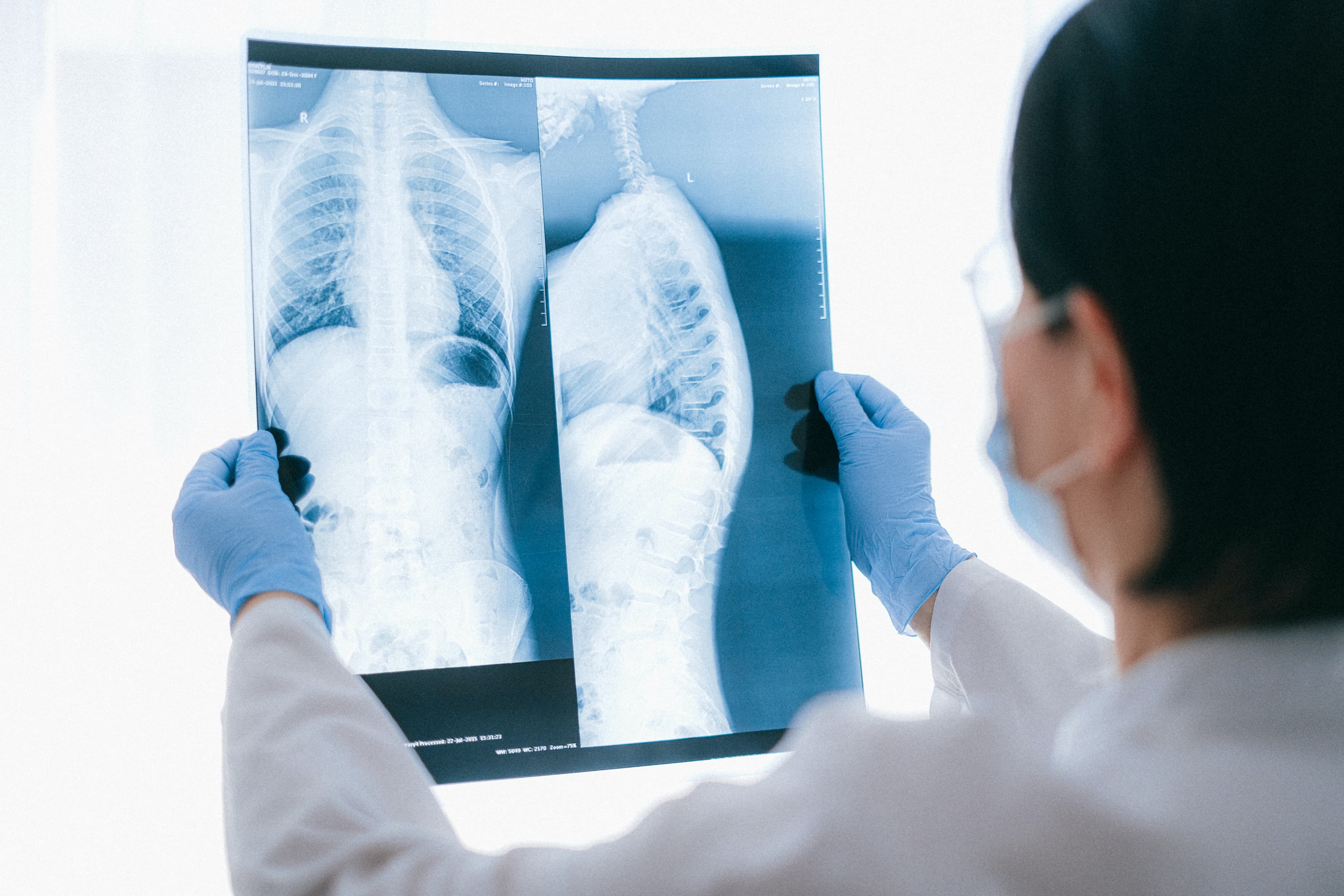 Pacient COVID-19 primește primul din lume transplant pulmonar de la donatorii vii