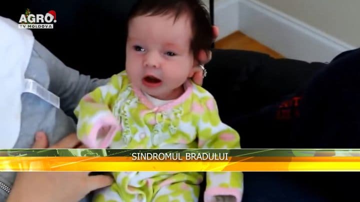 Sindromul bradului