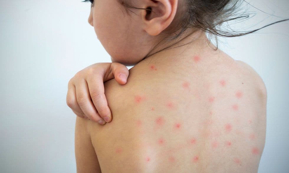 Focar de rujeolă la Cimișlia: Opt copii din diferite localități, infectați în ultima lună